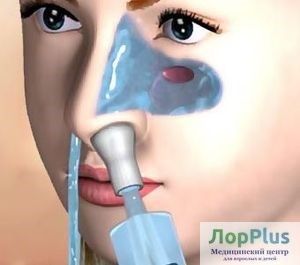 Промывание носа и околоносовых пазух методом перемещения жидкости