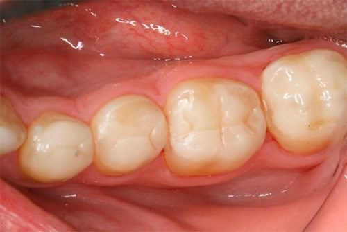 Качество пломбы - гарантия врача-стоматолога