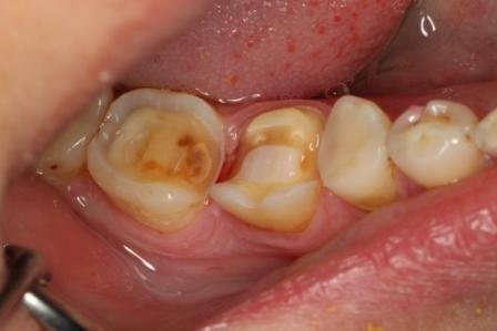 Некачественная пломба в зубе