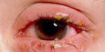 Глазные заболевания - блефарит